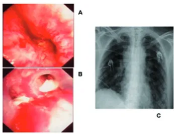 Fig. 6. Fistule broncho-pleurale après pneumonectomie gauche, confirmée par scanner (A) et endoscopie (B), fermeture de la fistule par une prothèse auto-expansible en nitinol couverte de type «  Tra-chéobronxane » : vue endoscopique de la trachée et du tro