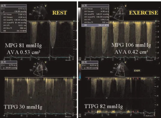 Figure 1 Example of a patient with abnormal exercise test in whom signiﬁcant increase in mean transaortic pressure gradient (MPG) was observed during rest
