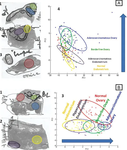 Figure 3. PCA analysis of the two pa- pa-tient tissues with endometrioid  ovar-ian cancer