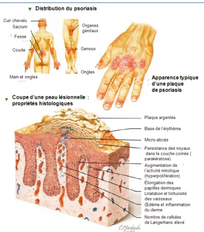 Figure  0.22.  Régions  préférentiellement  touchées  par  le  psoriasis  et  caractéristiques  morphologiques d'une peau psoriasique (adaptée de [67])