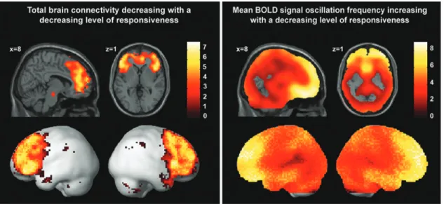 FIG. 3. Left: brain regions in which decreased connectivity correlated with loss of responsiveness, using the following contrast—wakefulness: 1, mild sedation: 0.5, unresponsiveness: 1.5, and recovery: 1; at false discovery rate corrected p &lt; 0.05