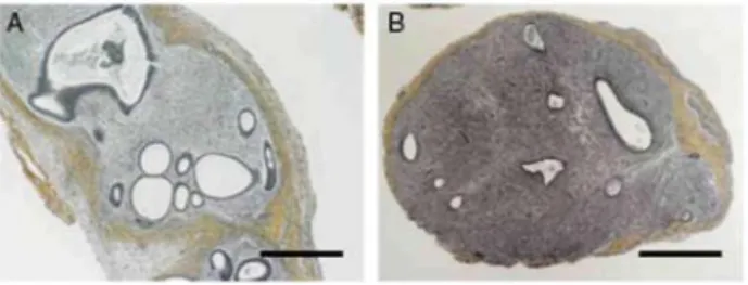 Figure 1   Haematoxylin-safran staining at 4 weeks after (A) endometrial graft in SCID mouse treated with E 2 ;  (B) endometrial graft in SCID mouse treated with E 2  + LNG