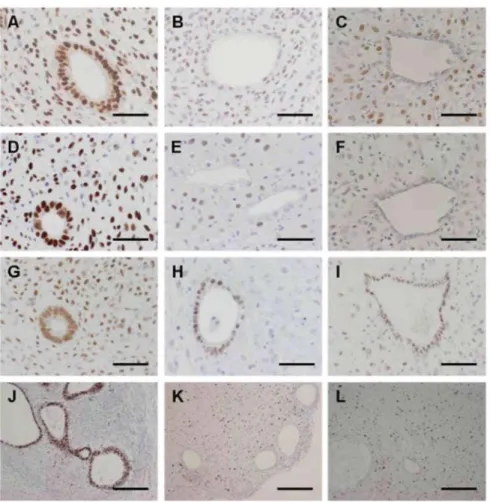 Figure 6 Immunoperoxidase staining with monoclonal species-specific anti-human PRA (A-C), PRB (D-F),   ERα (G-I) and Ki67 (J-L) antibodies