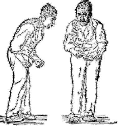 Figure 1. Illustration démontrant la posture d'un patient atteint de la maladie de Parkinson