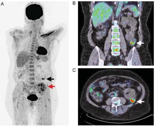 Fig. 2. Representative PET after intravenous injection of 18 FDG, coupled with CT, of cyst infection in patients with ADPKD