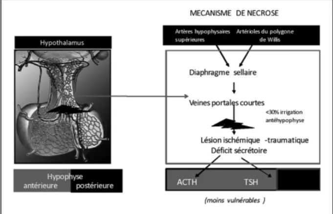 Figure 1b. Une lésion hypophysaire intéressant les veines portales courtes se  traduit habituellement par un déficit sécrétoire d’ACTH et TSH, avec  préser-vation de la région postérieure et latérale sécrétant GH, LH, FSH et PRL.