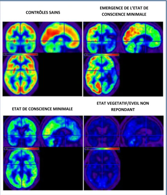 Figure 2. Métabolisme cérébral global chez des sujets témoins et chez des patients en état de conscience altérée mesuré à l’aide du