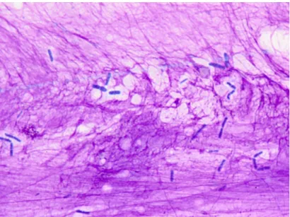 Figure 3: bile aspirate (Wright Giemsa, x1000 magnification) 