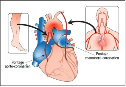 Figure 2: Intervention par pontage aorto-coronarien, tirée du site: www.icm-mhi.org 