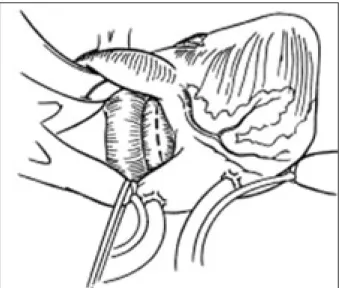 Fig. 6. Abord transseptal inférieur de Couëtil.