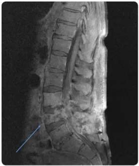 Figure 4. IRM. Coupe sagittale médiane pondérée  T1 (+C) : Processus érosif et infiltrant centré sur 