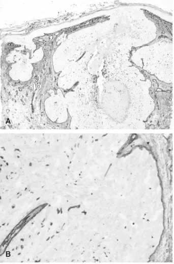 Fig. 2. Absence of peritumoral a5 (IV) collagen chain with positivity at the dermoepidermal junction (200).