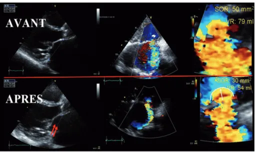 Figure  1  :  Images  échocardiographiques  obtenues  avant  (en  haut)  et  6  mois  après  (en bas) annuloplastie percutanée chez une  patiente  présentant  une  sévère  insuffisance  mitrale ischémique