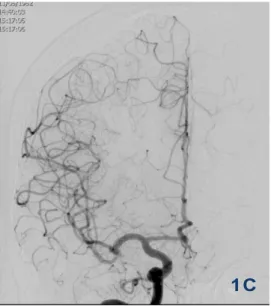 Figure 1. Exclusion chirurgicale d’un anévrisme sylvien droit par mise en place d’un clip