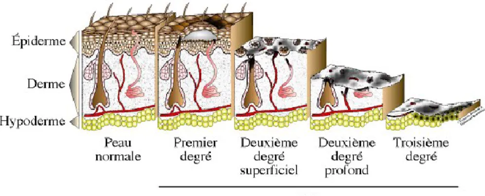 Figure 11 : Types de plaies cutanées 