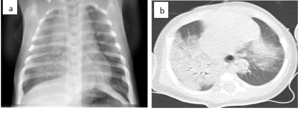Fig. 1: (a) Chest radiography showed diffuse alveolar infiltrates mostly in the right pulmonary 178 