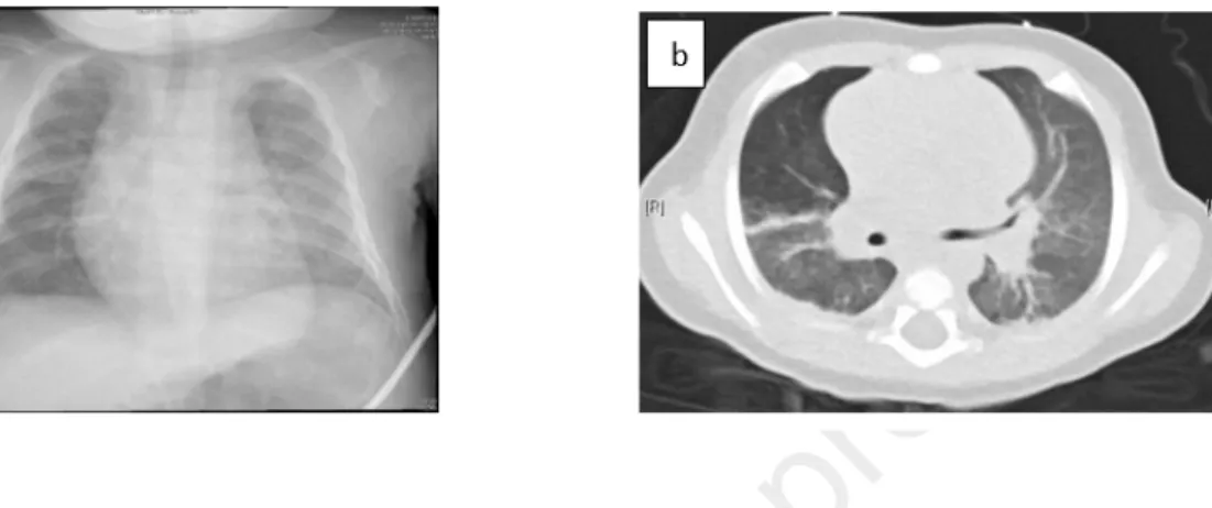 Fig  2:  (a)  Chest  radiograph  demonstrated  bilateral  alveolo-interstitial  opacities