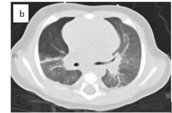 Fig  2:  (a)  Chest  radiograph  demonstrated  bilateral  alveolo-interstitial  opacities