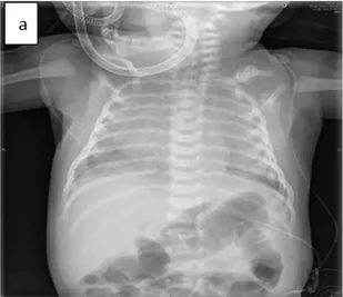Fig 4: (a) Chest x-ray showed diffuse alveolar infiltrates. 