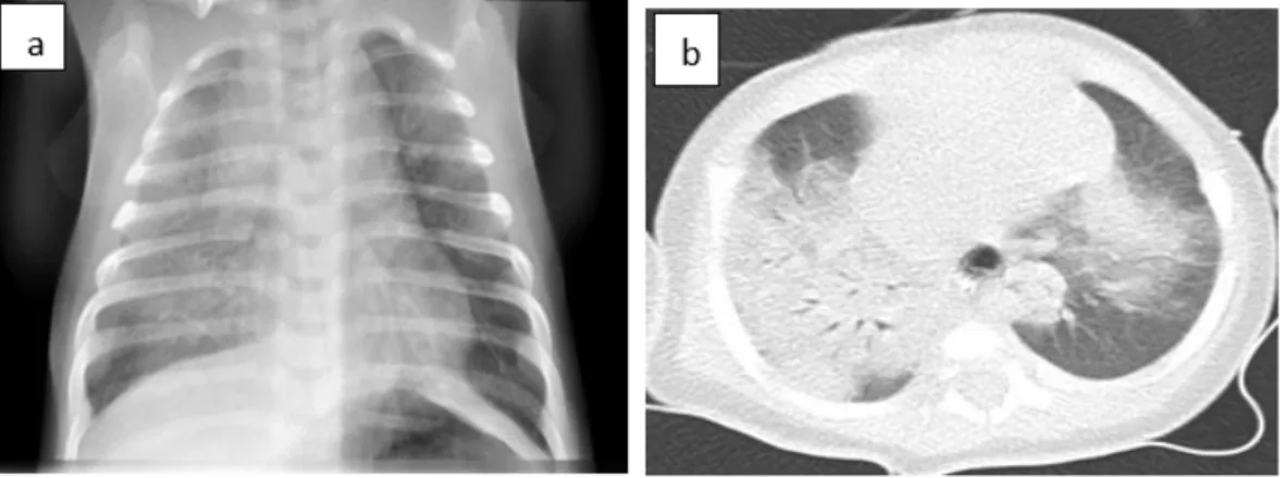 Fig. 1: (a) Chest radiography showed diffuse alveolar infiltrates mostly in the right pulmonary  hemi-field