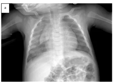 Figure  5:  (a)  Chest  radiography  showed  diffuse  alveolar  infiltrates  at  the  right  pulmonary  hemifield