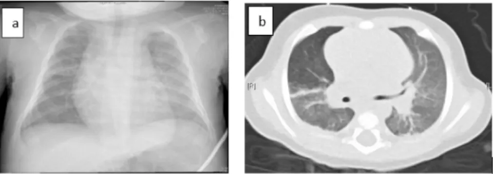 Fig. 2. (a) Chest radiograph demonstrated bilateral alveolo-interstitial opacities. (b) Chest computed tomography scan showed diffuse bilateral alveolar and ground-  glass opacities