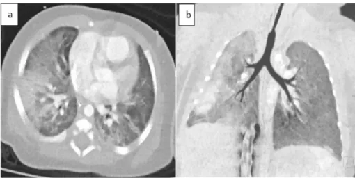 Fig. 4. (a) Chest x-ray showed diffuse alveolar infiltrates.  