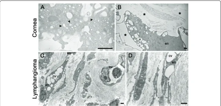Figure 4 Vacuolization and lumen formation during lymphangiogenesis in vivo . Lymphangiogenesis was observed after thermal cauterization of the cornea (A, B) and in lymphangioma (C, D)