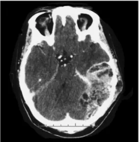 Figure 1. Computed tomographic (CT) scan after intravenous administration of contrast showing a left  hyperdense tumor with both supratentorial and infratentorial extension