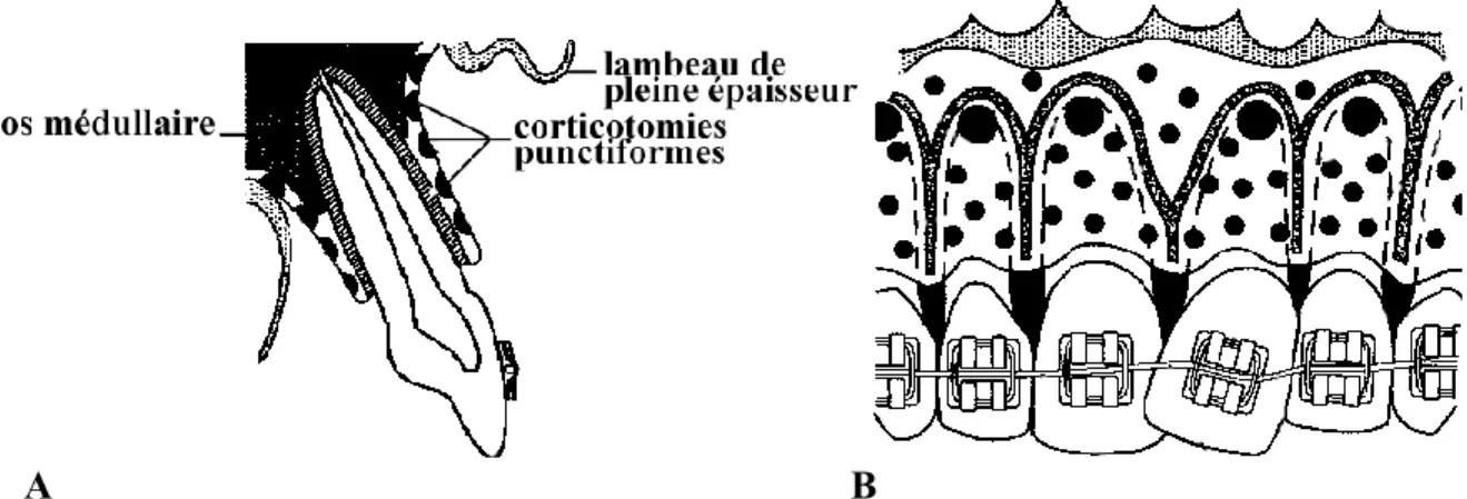 Figure 1 : A. Coupe sagittale au niveau d’une incisive maxillaire au  cours de la réalisation de corticotomies