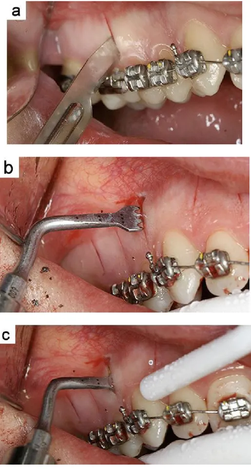 Figure 6 : Réalisation d’une corticotomie par Piézocision (a : réalisation des incisions / b  et c : réalisation de la Piézocision)  (30) 