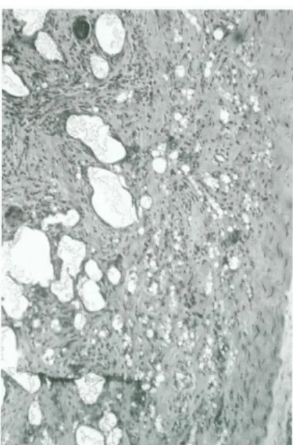Figure 27. Aspect de « cratères » au niveau de la couche interne de la capsule au contact des  prothèses macrotexturées Biocell 