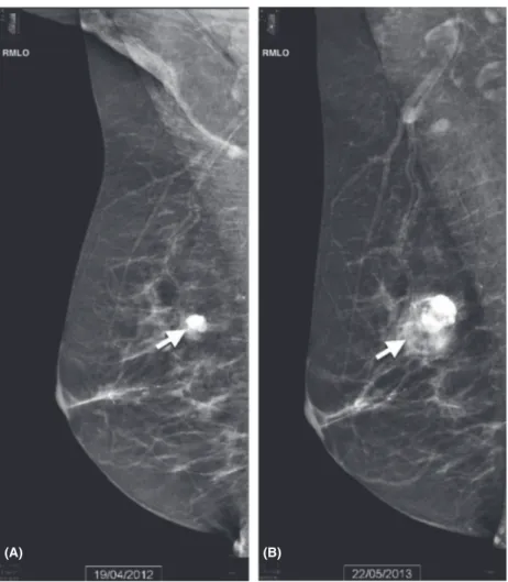 Figure 1. Mediolateral oblique view of the right breast demonstrates (A) in April 2012, the presence of a calcified fibroadenoma (arrow) and (B) in May 2013, a dense opacity, slightly heterogeneous with numerous calcifications in the part upper outer of th