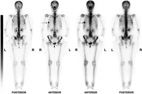 Figure 2. Technetium 99-methylene diphosphonate bone scintigraphy showing an intense uptake in the right breast corresponding to the primary osteosarcoma (arrows).