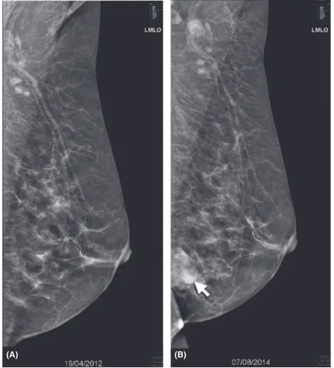 Figure 4. Mediolateral oblique view of the left breast (A) in April 2012, no abnormality is detected and (B) in August 2014, a dense nodular opacity, with slightly irregular outline in the infero-medial region, is observed (arrow).