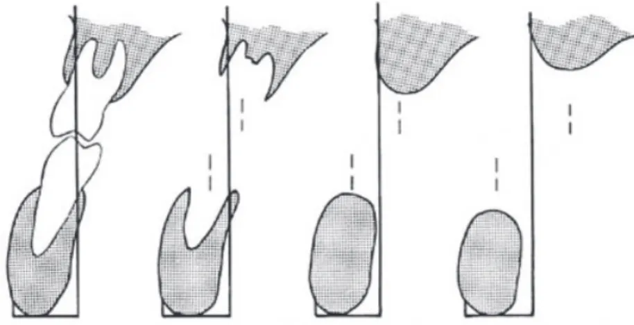 Figure 5 : Progression du décalage antéro-postérieur des arcades 