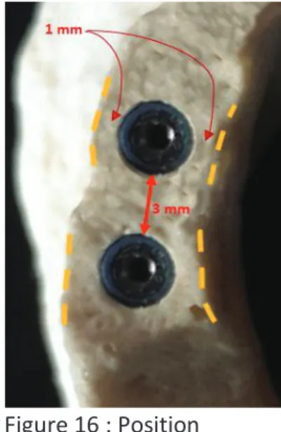 Figure 16 : Position  vestibulo-linguale et  distance inter-implantaire 