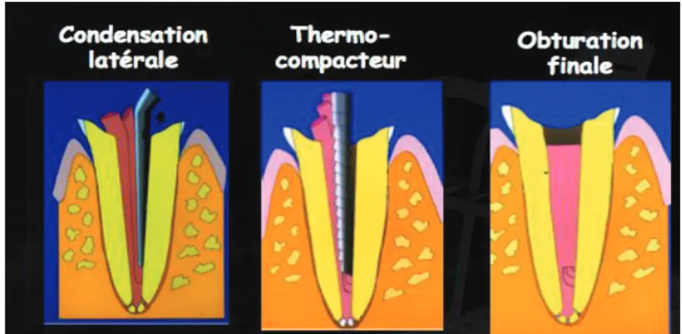 Figure 15 : Schéma montrant les étapes de la technique de Peli (13) 