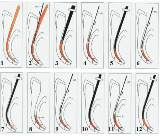 Figure 16 : Schéma montrant les étapes de la technique de Schilder : (36)