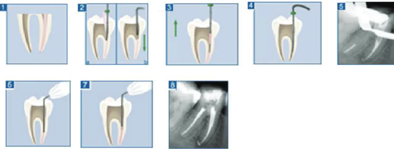 Figure 20 : Schéma montrant les étapes de la technique du System B® : (41) 