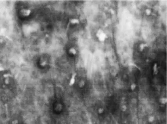 Fig. 1 : Multiples comédons habitant tous les ostiums folliculaires en cas d’intoxication par le TCDD