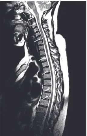 Fig 4 : IRM médullaire en coupe sagittale montrant des lésions de SEP 