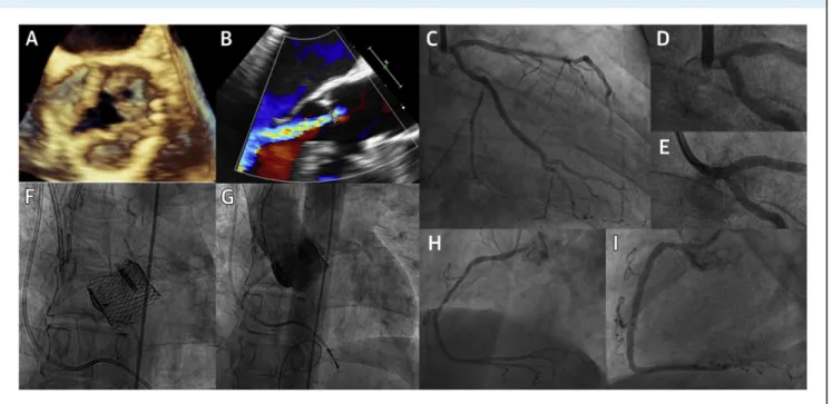 FIGURE 8 A Patient With RACD Who Underwent TAVR