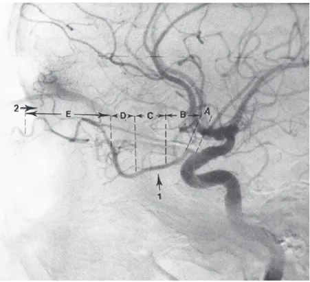 Figure 3 : Angiographie carotidienne interne montrant les différents segments de l’artère ophtalmique