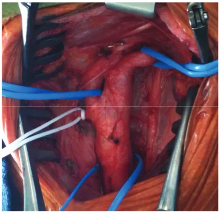 Figure 8 : Vue peropératoire d’une portion cervicale de la carotide : 