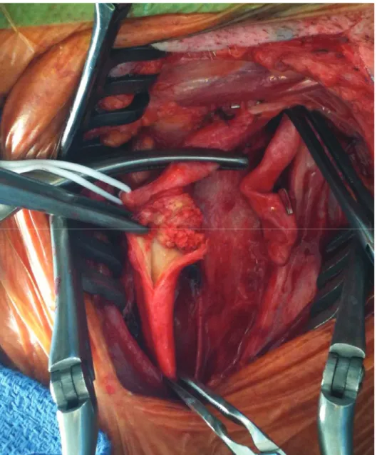 Figure 10: Vue peropératoire d’une chirurgie de sténose carotidienne. La plaque endoluminale est visible après  section de la carotide 