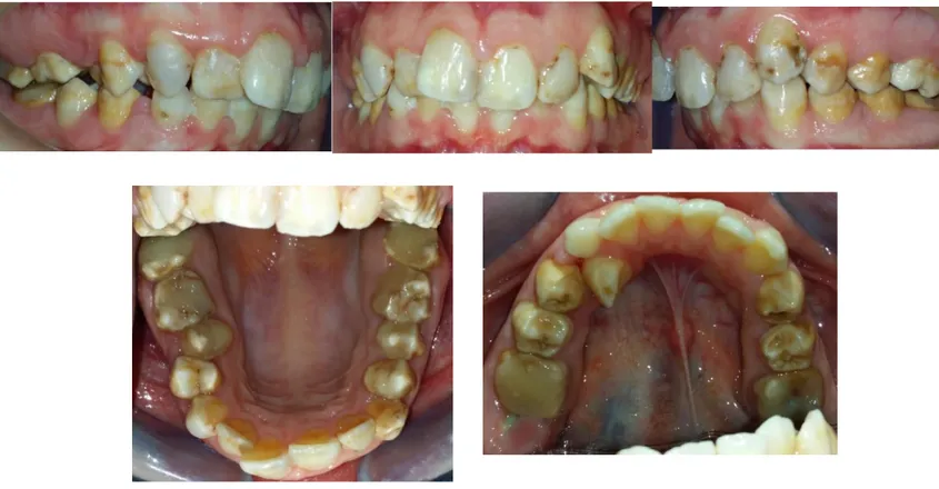 Figure 3 : Photos intra-orales de Z.K