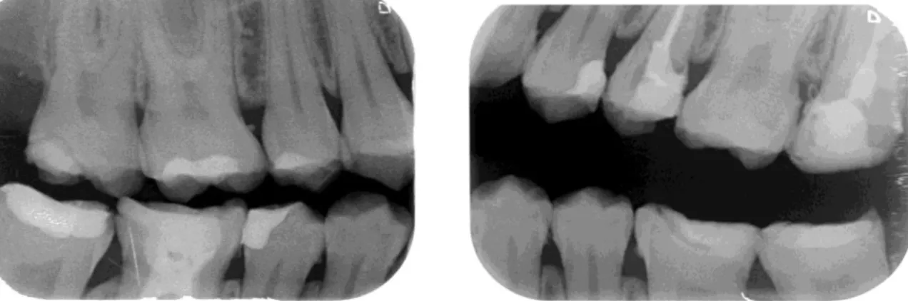 Figure 6 : Rétrocoronaires de Z.A 