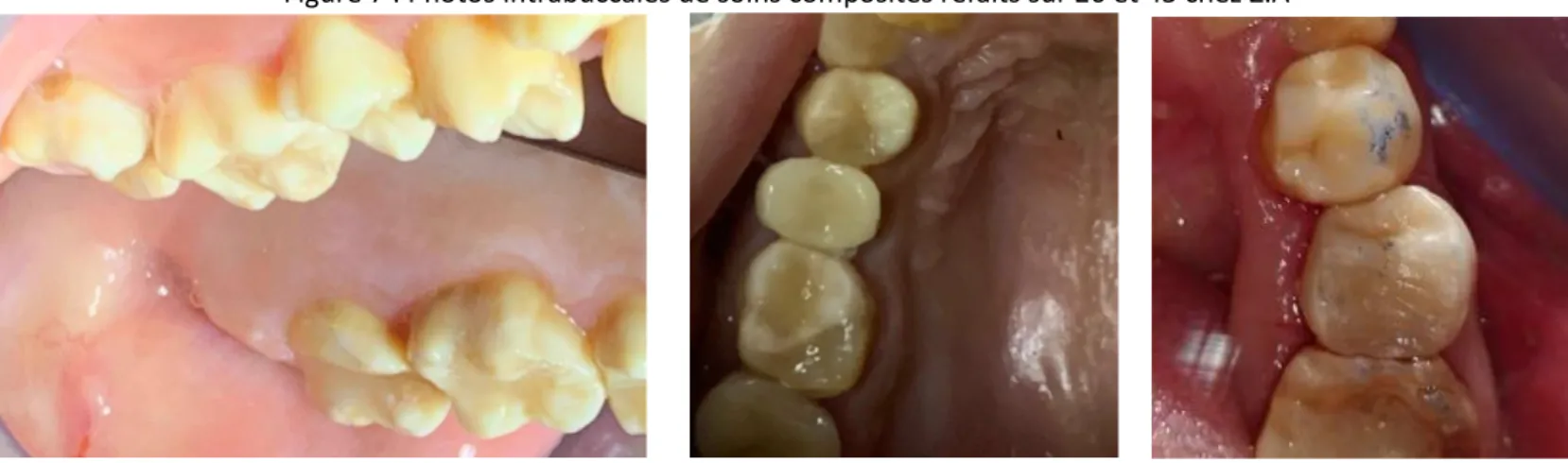 Figure 7 : Photos intrabuccales de soins composites refaits sur 26 et 45 chez Z.A 