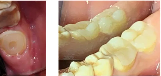 Figure 9 : Photos intrabuccales de préparation + IDS sur 36 et 37 (à gauche) et de pose de l’onlay sur  36 et de l’overlay sur 37 (à droite) 
